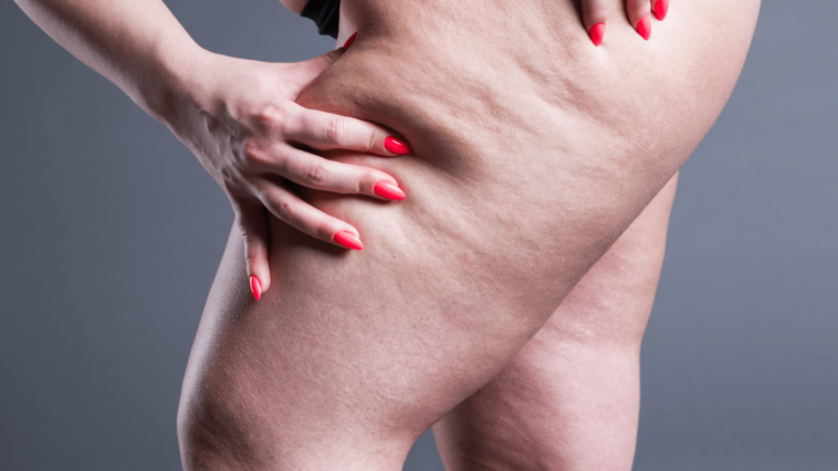 Does walking reduce cellulite?