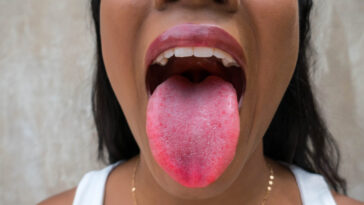 Does your tongue look weird with Covid?