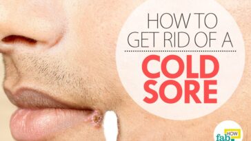 How I get rid of my cold sore overnight?