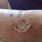 How are biofilm wounds removed?