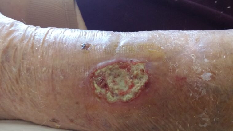 How are biofilm wounds removed?