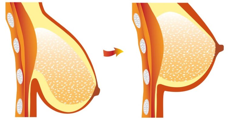 How can I firm my saggy breasts in a week?