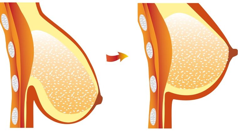 How can I firm my saggy breasts in a week?