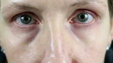 How can I get more oxygen to my eyes?