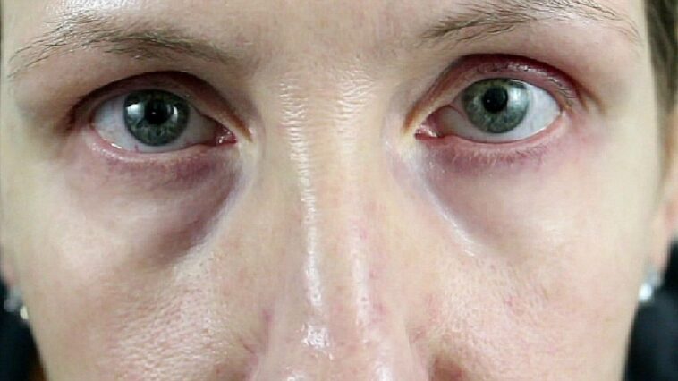 How can I get more oxygen to my eyes?
