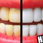 How can I get whiter teeth?