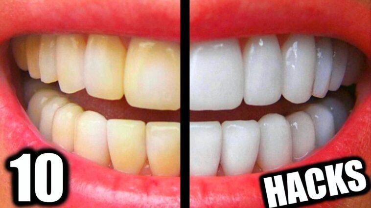 How can I get whiter teeth?