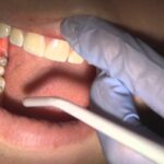How do I know if a tooth is infected?
