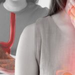 How do you cure GERD permanently?