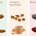 How do you know if you have a blockage in your colon?