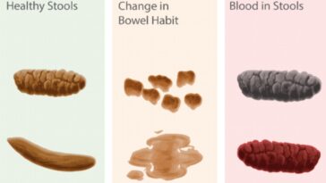 How do you know if you have a blockage in your colon?