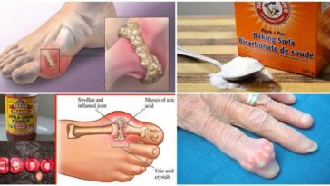 How do you remove acid from your body?