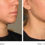 How do you tighten loose skin under your chin?