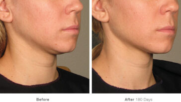 How do you tighten loose skin under your chin?