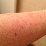 How long does it take for a food allergic reaction to go away?