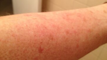 How long does it take for a food allergic reaction to go away?