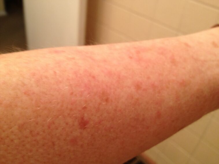 How long does it take for a food allergic reaction to go away?