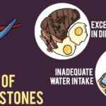 How much protein is too much for kidney stones?