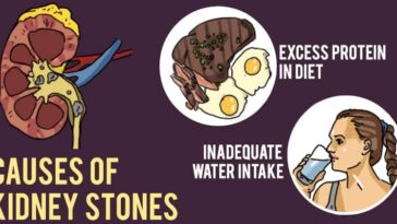 How much protein is too much for kidney stones?