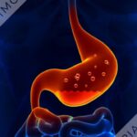 Is Kool-Aid okay for acid reflux?