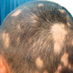 Is alopecia areata harmful?