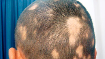 Is alopecia areata harmful?