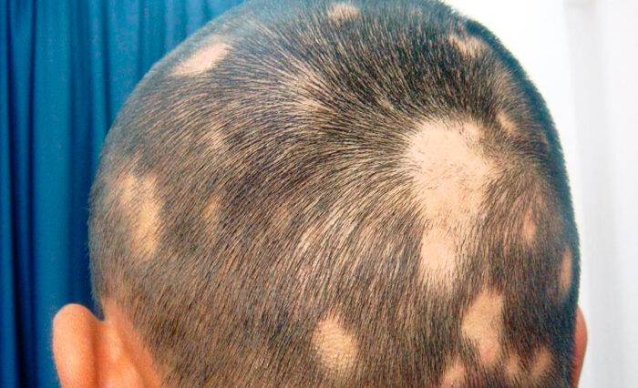 Is alopecia areata harmful?