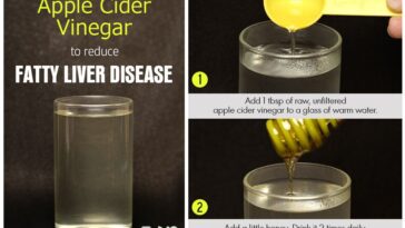 Is apple cider vinegar good for fatty liver?