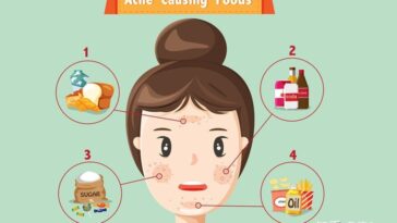 Is chips can cause acne?