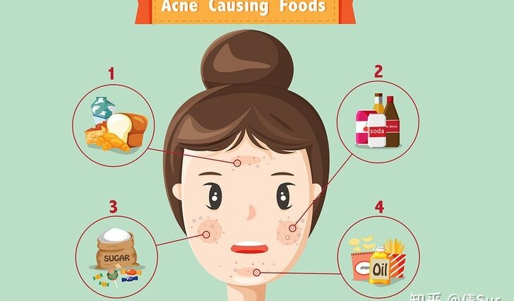 Is chips can cause acne?