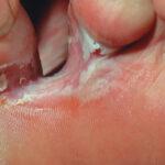 Should I dry between my toes?