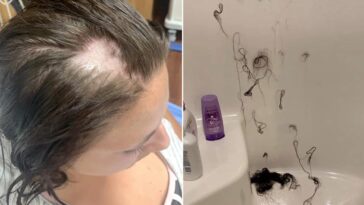 What am I lacking if my hair is falling out?