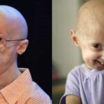 What causes rapid aging?