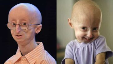 What causes rapid aging?