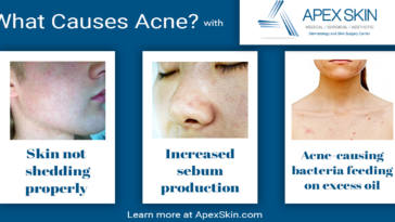 What cereals dont cause acne?