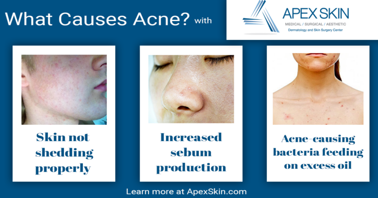 What cereals dont cause acne?