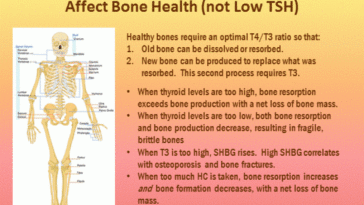 What does hypothyroidism do to bones?