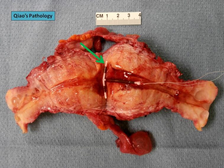 What does mugwort do to the uterus?