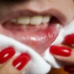 What foods aggravate cold sores?