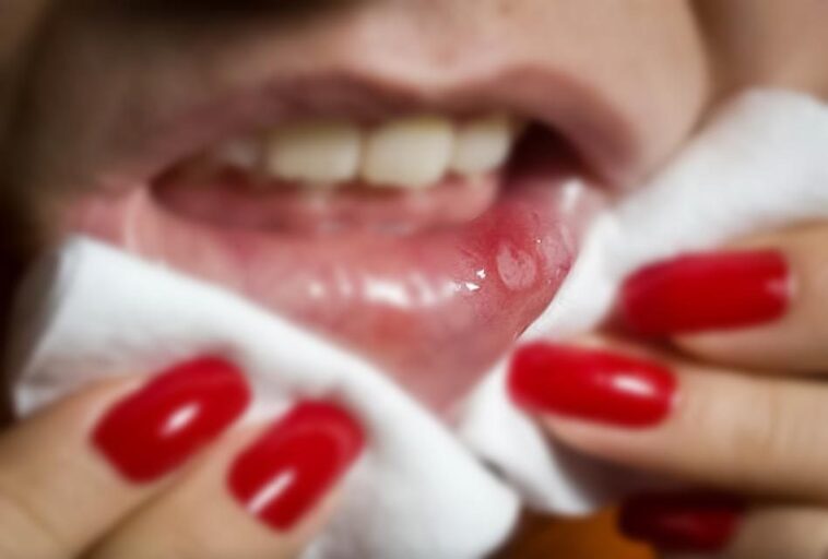 What foods aggravate cold sores?