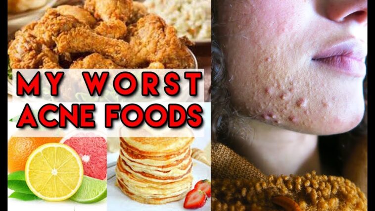 What foods are causing my acne?