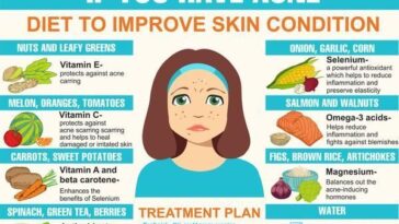 What foods help clear acne?