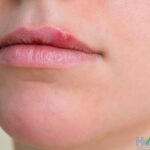 What gets rid of cold sores overnight?