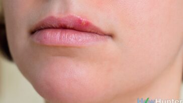 What gets rid of cold sores overnight?