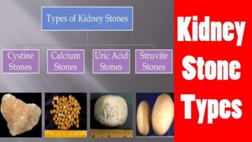 What kind of tea causes kidney stones?