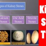 What kind of tea causes kidney stones?