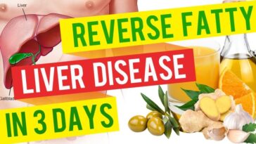 What supplement is best for fatty liver?