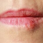 What vitamin deficiency causes cold sores?