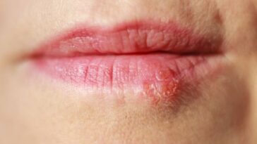 What vitamin deficiency causes cold sores?