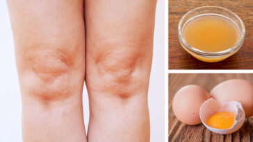 Which protein causes joint pain?